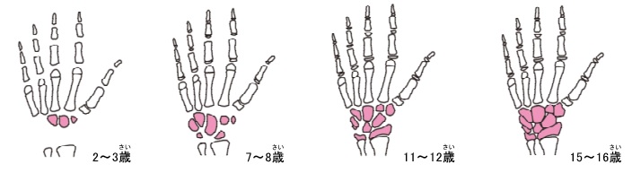 年齢ごとの、手の骨を構成する骨の密度が示されている。年齢が増すごとに骨の密度が高くなっている。