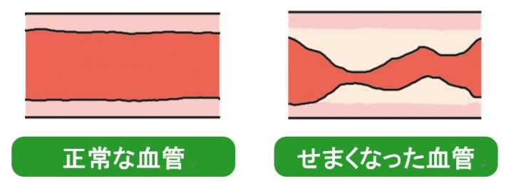 物が詰まっていない血管と物が詰まっている血管